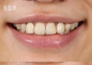 A Billion-Dollar Market: 80μm Ultra-Thin 3D-Printed Zirconia Dental Veneers—Ivoclar Partners with BMF PRECISION TECH for Global Launch