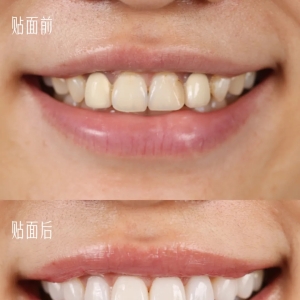A Billion-Dollar Market: 80μm Ultra-Thin 3D-Printed Zirconia Dental Veneers—Ivoclar Partners with BMF PRECISION TECH for Global Launch